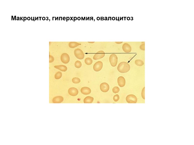 Макроцитоз, гиперхромия, овалоцитоз